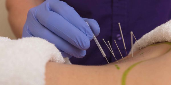 Why Does Adding Electricity to Dry Needling Make It More Effective? -  Western Slope Rehab & Performance